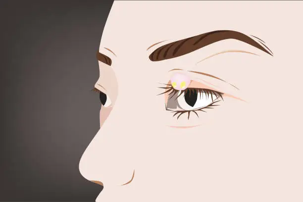 Vector illustration of Trachoma on the surface of eye