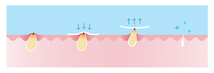 Step of blackhead removal vector illustration on blue sky background. Cross section of blackhead pore strip treatment, apply, peel off, unclogging and tighten pore. Skin care and beauty concept.
