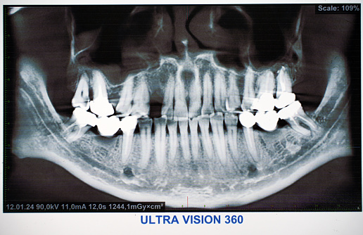 Panoramic Dental X-Ray with broken tooth, close-up