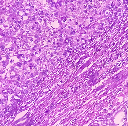 Kidney cancer: Clear cell carcinoma. fuhrman nuclear grade-II, Renal growth shows a malignant tumor, renal cell carcinoma in between renal tubules.