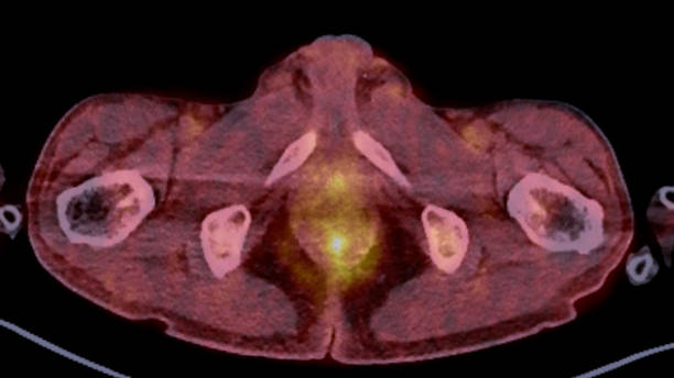 istock A PET-CT scan image is a diagnostic visualization combining Positron Emission Tomography (PET) and Computed Tomography (CT) for Helps in finding cancer recurrence. 1929982526