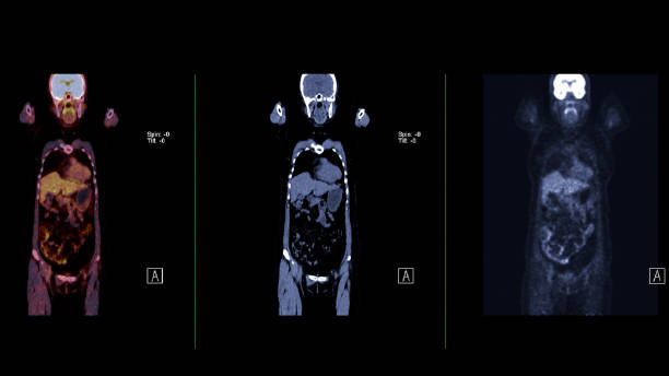 istock A PET-CT scan image is a diagnostic visualization combining Positron Emission Tomography (PET) and Computed Tomography (CT) for Helps in finding cancer recurrence. 1929992654