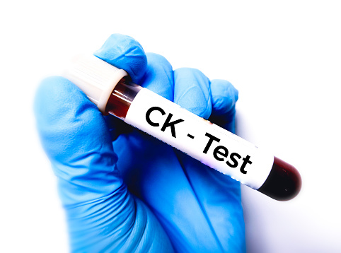 CK Test Medical check up test tube with biological sample. Isolated on a white background.
