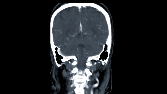 CT scan of the brain Axial view  for diagnosis brain tumor,stroke diseases and vascular diseases.