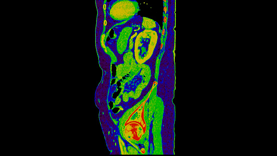 CT scan of  Abdomen  sagittal view with injection contrast media with green color mode coronal view for diagnosis  abdominal diseases.