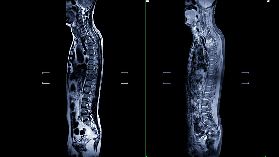 An MRI of the whole spine image is a comprehensive visual representation produced through Magnetic Resonance Imaging, providing detailed insights into the entire spinal structure.
