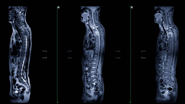 An MRI of the whole spine image is a comprehensive visual representation produced through Magnetic Resonance Imaging, providing detailed insights into the entire spinal structure. una resonancia magnética de toda la imagen de la columna vertebral es una representación visual completa producida a través de imágenes de resonancia magnética, que proporciona información detallada sobre toda la estructura de la columna vertebral.