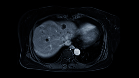 MRI of the upper abdomen axial view is a non-invasive imaging technique providing detailed visuals of organs like the liver, pancreas, and kidneys.