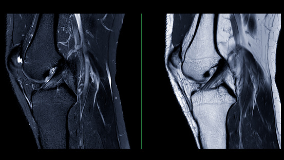 Magnetic resonance imaging or MRI of  knee joint. This diagnostic technique is crucial for assessing ligaments, cartilage, and identifying issues like tears or inflammation.