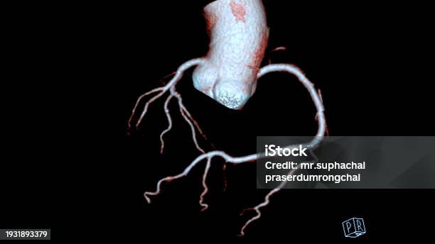 Cta Coronary Artery 3d Rendering Is A Diagnostic Imaging Technique ...