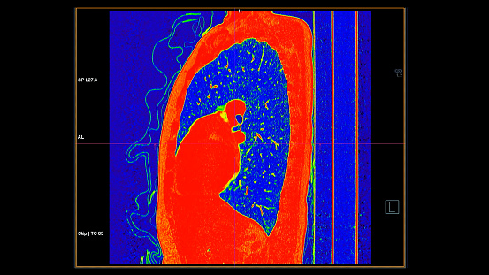 CT scan of Chest coronal view in color mode  for diagnostic Pulmonary embolism (PE) , lung cancer and covid-19.