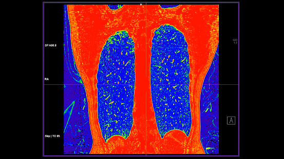 CT scan of Chest coronal view in color mode  for diagnostic Pulmonary embolism (PE) , lung cancer and covid-19.