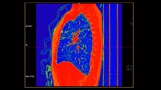 CT scan of Chest sagittal view in color mode  for diagnostic Pulmonary embolism (PE) , lung cancer and covid-19.