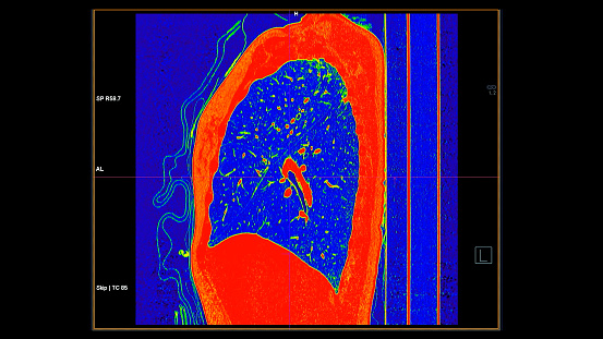 CT scan of Chest sagittal view in color mode  for diagnostic Pulmonary embolism (PE) , lung cancer and covid-19.
