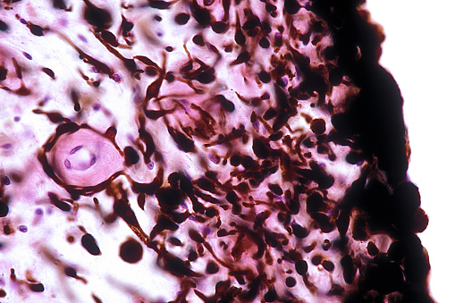 Light micrograph of the anterior surface of a heavily pigmented human iris lined by stromal fibroblasts and abundant melanocytes. It is one of the few body surfaces not lined by an epithelium. Beneath is the iris stroma also with many melanocytes. This iris belongs to a deep brown or black eye.