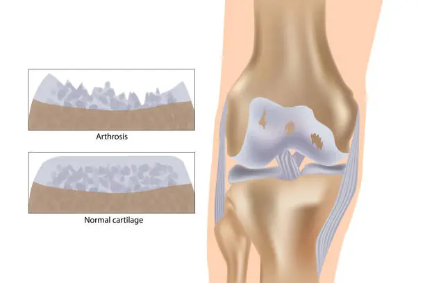 Vector illustration of Medical vector illustration with damaged knee structure and healthy knee comparison. Knee arthrosis.