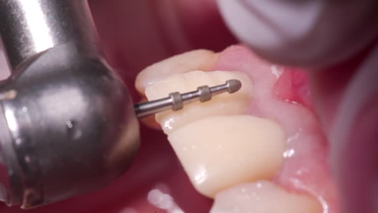 Close-up shot of removing partly teeth enamel by dental diamond bur. Dentist preparing woman's teeth for installing zirconia veneers and crowns using the dental bur. Dentistry, prosthetics concept.