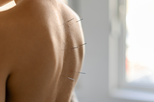 A young woman getting an acupuncture treatment on her back. She is standing in the doctor's office, with acupuncture needles on her back.