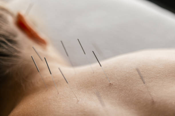 Patient getting acupuncture back treatment A young woman getting an acupuncture treatment on her back. she is lying face down on the bed. acupuncture model stock pictures, royalty-free photos & images