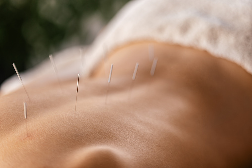 A young woman getting an acupuncture treatment on her back. She is lying face down on the bed.