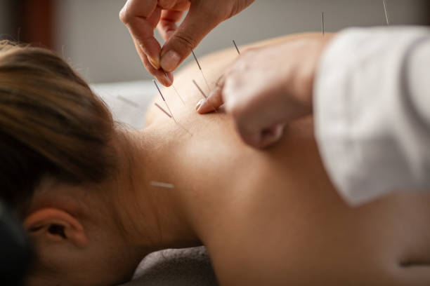 Acupuncture back treatment, therapist and patient A young woman getting an acupuncture treatment on her back. She is lying face down on the bed. acupuncture stock pictures, royalty-free photos & images