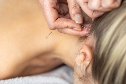 A young woman getting an acupuncture treatment on her head, ear and neck. She is lying face down on the bed.