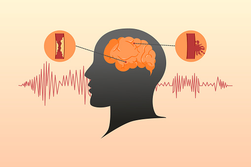 Stroke disease concept. Ischemic and hemorrhagic. Scientific medical illustration of human brain stroke. Vector illustration.