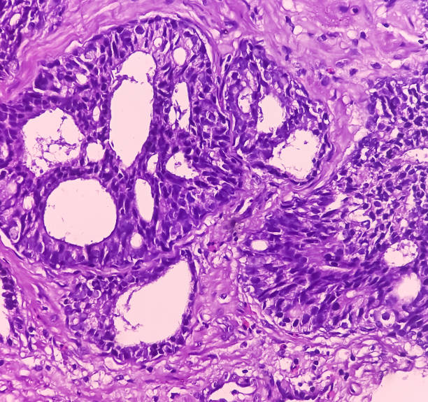 istock Prostatic chips (TURP): Adenocarcinoma. Sections show core of prostatic tissue. It reveals an infiltrating adenocarcinoma. Prostate cancer. 1934193948