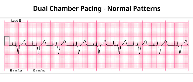 ECG Dual Chamber Pacemaker Rhythm - Normal Pattern - 8 Second ECG Paper - Electrocardiography Vector Medical Illustration