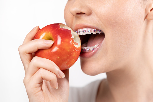 Close up of young woman with braces biting off red apple. White background. Concept of forbidden food during orthodontic treatment.