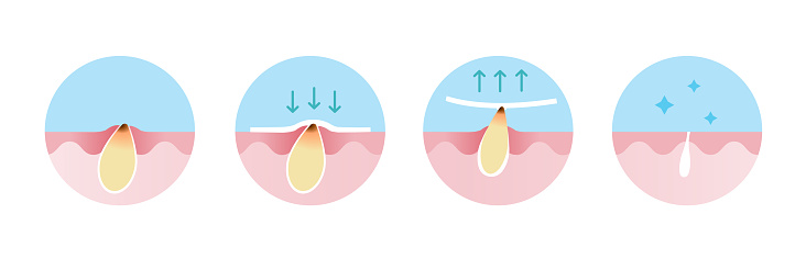 Step of blackhead removal vector icon set illustration isolated on white background. Cross section of blackhead treatment process, apply, peel off, unclogging and tighten pore. Skin care and beauty concept.
