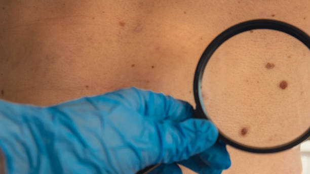 istock Mole dermoscopy, preventive of melanoma. Dermatologist examining patient's birthmark with magnifying glass in clinic. Checking benign moles. Skin abnormalities care 1936639816