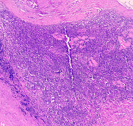 Thyroid cancer: Microscopic image of Follicular neoplasm. Malignant neoplasm of atypical thyroid follicular epithelial cells. Some of cells show pleomorphism with nuclear grooving. Nodular goiter.