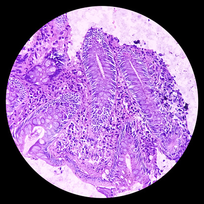 Ileo-cecal ulcer (biopsy): Chronic nonspecific ileitis with ulcer. Section show ileal mucosa, dense infiltration of lymphocytes, histiocytes, plasma cell in lamina propria. IBD.