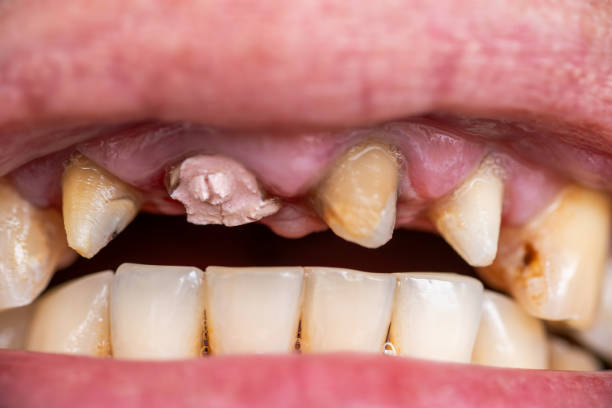 istock Broken tooth, missing teeth in open human mouth close up macro photo. Dental problems, dentistry medicine concept 1937518212