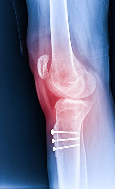 istock X-ray Knee Joint Fracture proximal tibia and Post fix fracture proximal tibia with plate and screws, highlighted in red 1937561685