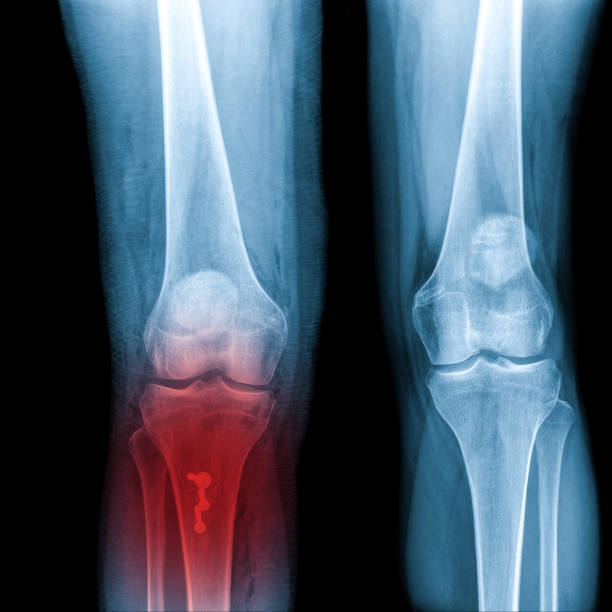 istock X-ray Knee Joint Fracture proximal tibia and Post fix fracture proximal tibia with plate and screws, highlighted in red 1937565984