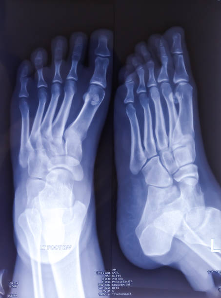 istock X-ray of foot both view. Normal radiograph. 1938741718