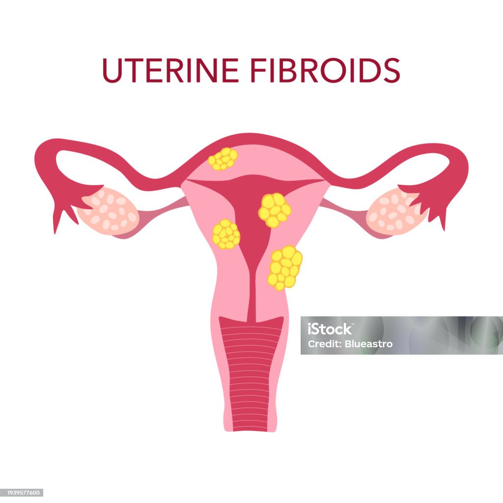 Fibrot Uterine Fibroids Disease In Flat Design Vector Illustration Stock ...