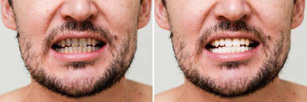 istock Man's teeth before and after whitening and alignment (braces). Oral care 1940657403