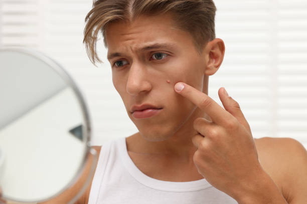 istock Upset young man looking at mirror and touching pimple on his face indoors. Acne problem 1940791055