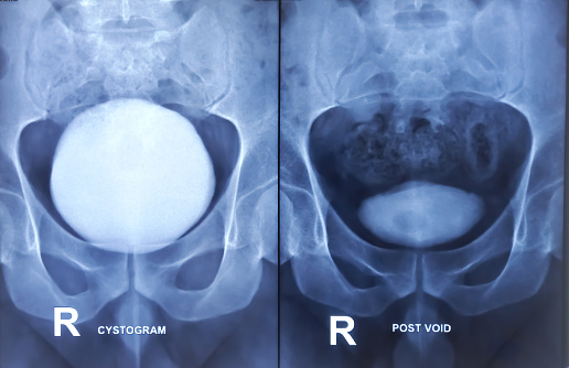 X-Ray film of RGU and MCU (Retrograde urethrogram and micturating cystogram). Radiological test that inject dye via  urethra to identify urethral narrowing. Narrow stream of urine with significant PVR