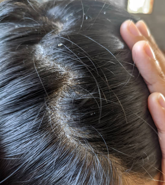istock Dandruff flakes between hair on the scalp 1941848474