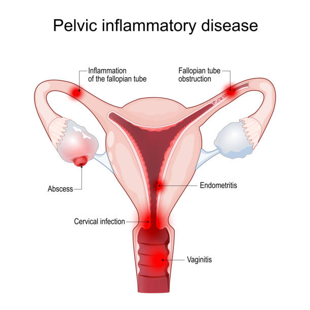 PID. Pelvic inflammatory disease Pelvic inflammatory disease. Cross section of a Uterus with symptoms of Inflammation, fallopian tube obstruction, endometritis, salpingitis, tubo-ovarian abscess, vaginitis and cervical infection. Female reproductive system and Sexually transmitted infection. Vector poster about Women's health pelvic inflammatory disease stock illustrations