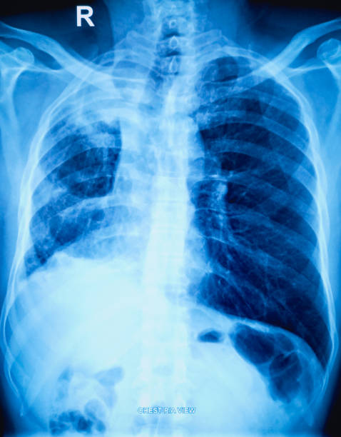 istock X-ray of the human chest. 1941956281