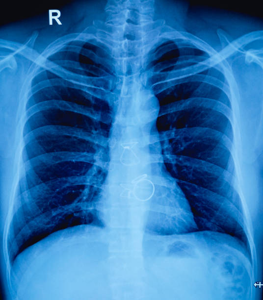 istock X-ray of the human chest. Post-CABG state. 1941956802