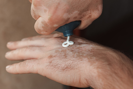 Male hands with Vitiligo Care using cream as a treatment for seasonal skin problems.