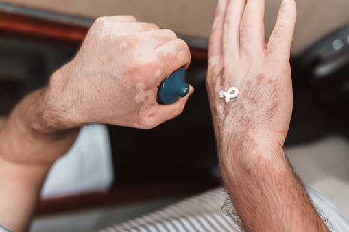 Male hands with Vitiligo Care using cream as a treatment for seasonal skin problems.