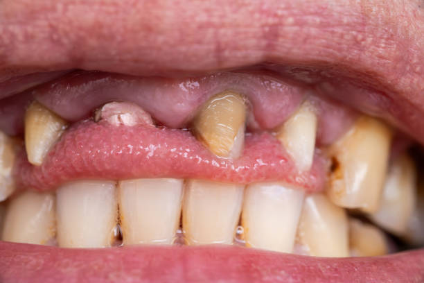 Broken tooth, missing teeth in open human mouth close up macro photo. Dental problems, dentistry medicine concept.