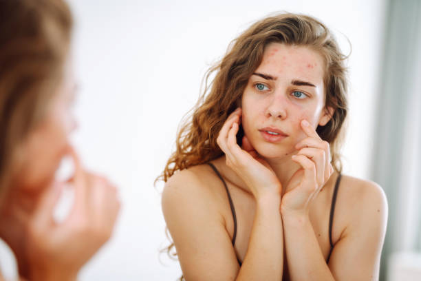 istock Skin Problem. Depressed Woman Touching Pimple On Face Looking At Mirror. 1943286397